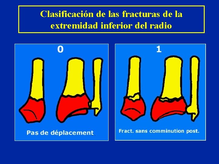 Clasificación de las fracturas de la extremidad inferior del radio Clasificación de las fracturas de la extremidad inferior del radio