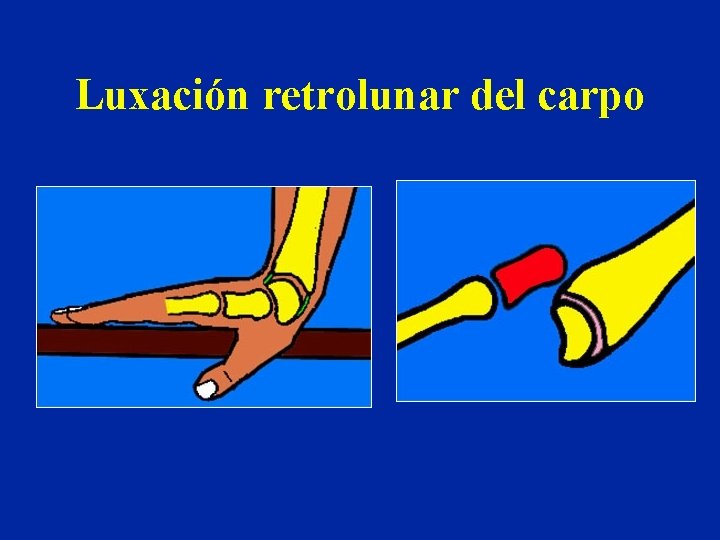 Luxación retrolunar del carpo Luxación retrolunar del carpo