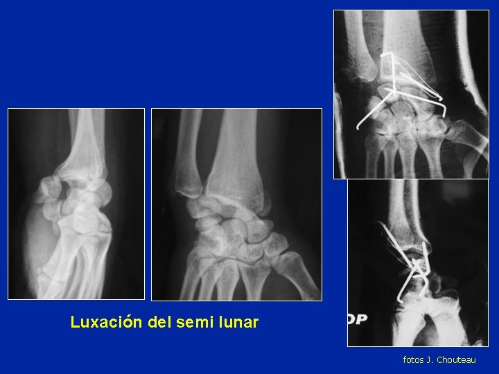 Luxación del semi lunar fotos J. Chouteau Luxación del semi lunar fotos J. Chouteau