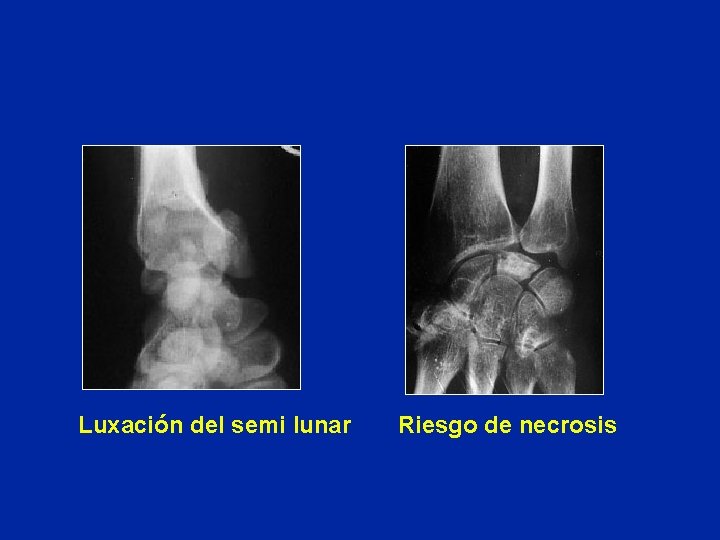 Luxación del semi lunar Riesgo de necrosis Luxación del semi lunar Riesgo de necrosis