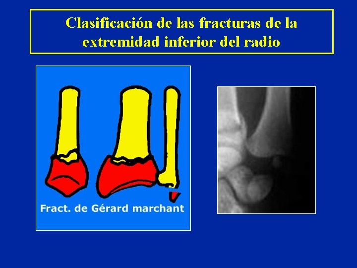 Clasificación de las fracturas de la extremidad inferior del radio Clasificación de las fracturas de la extremidad inferior del radio