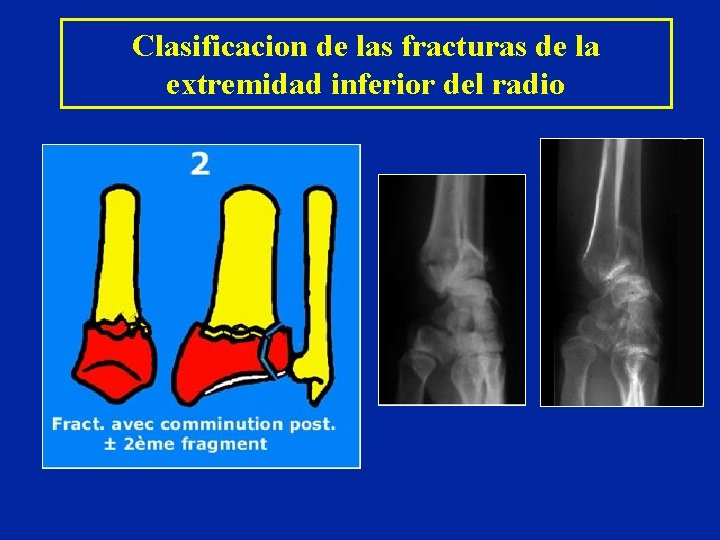 Clasificacion de las fracturas de la extremidad inferior del radio Clasificacion de las fracturas de la extremidad inferior del radio