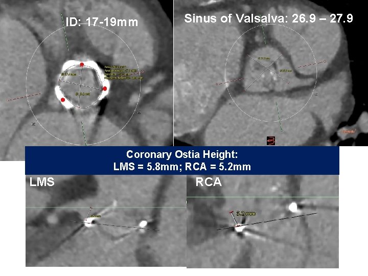 ID: 17 -19 mm Sinus of Valsalva: 26. 9 – 27. 9 Coronary Ostia ID: 17 -19 mm Sinus of Valsalva: 26. 9 – 27. 9 Coronary Ostia