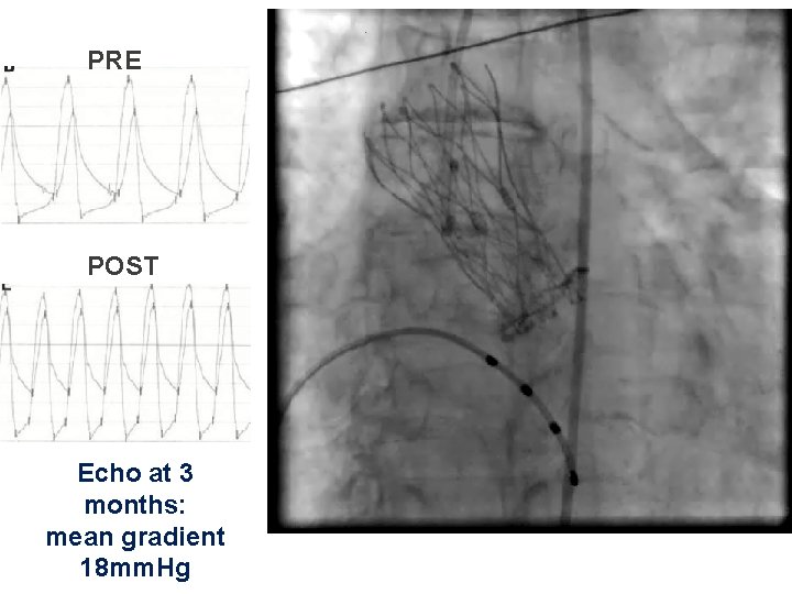 PRE POST Echo at 3 months: mean gradient 18 mm. Hg PRE POST Echo at 3 months: mean gradient 18 mm. Hg