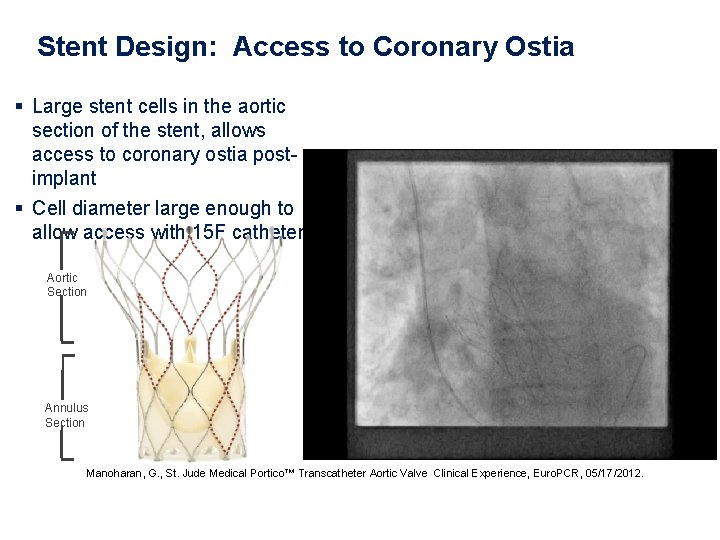 Stent Design: Access to Coronary Ostia § Large stent cells in the aortic section Stent Design: Access to Coronary Ostia § Large stent cells in the aortic section