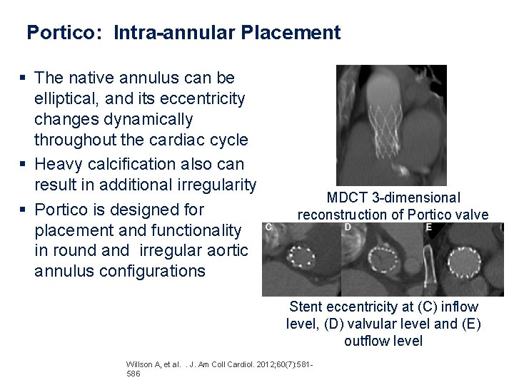 Portico: Intra-annular Placement § The native annulus can be elliptical, and its eccentricity changes Portico: Intra-annular Placement § The native annulus can be elliptical, and its eccentricity changes