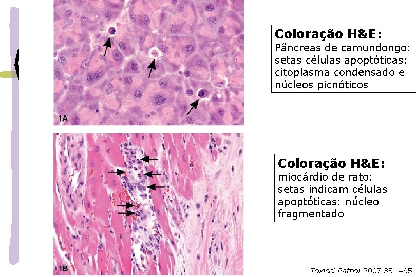 Coloração H&E: Pâncreas de camundongo: setas células apoptóticas: citoplasma condensado e núcleos picnóticos Coloração