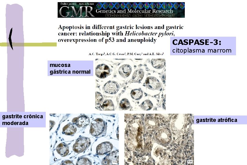 CASPASE-3: citoplasma marrom mucosa gástrica normal A gastrite crônica moderada gastrite atrófica C 