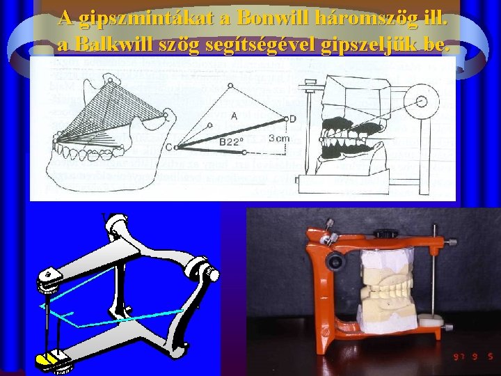 A gipszmintákat a Bonwill háromszög ill. a Balkwill szög segítségével gipszeljük be. 