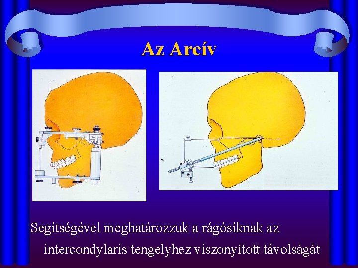 Az Arcív Segítségével meghatározzuk a rágósíknak az intercondylaris tengelyhez viszonyított távolságát 