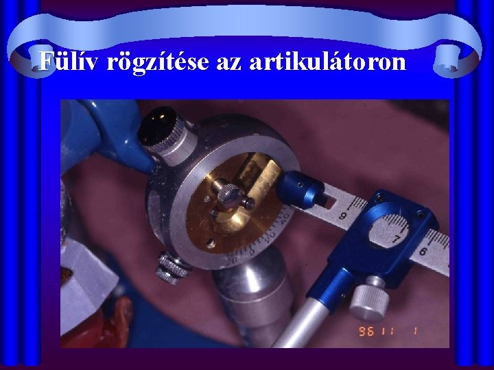 Fülív rögzítése az artikulátoron 