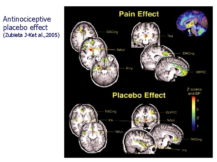 Antinociceptive placebo effect (Zubieta J-Ket al. , 2005) 