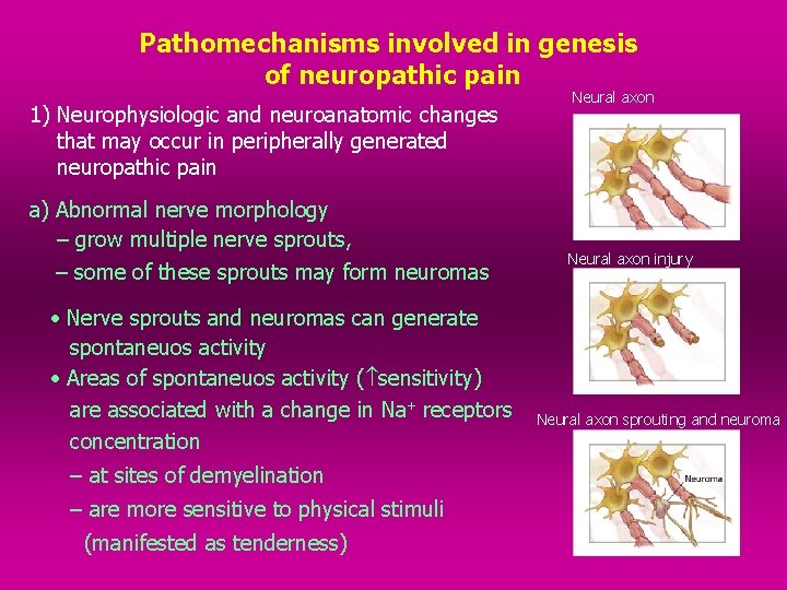 Pathomechanisms involved in genesis of neuropathic pain 1) Neurophysiologic and neuroanatomic changes that may