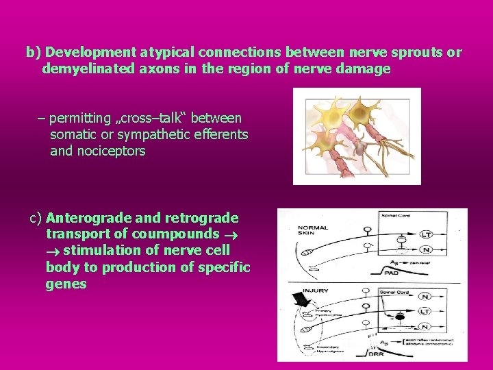 b) Development atypical connections between nerve sprouts or demyelinated axons in the region of