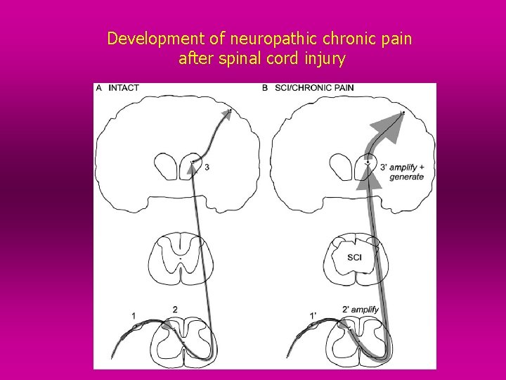 Development of neuropathic chronic pain after spinal cord injury 
