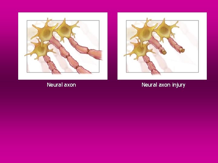 Neural axon injury 