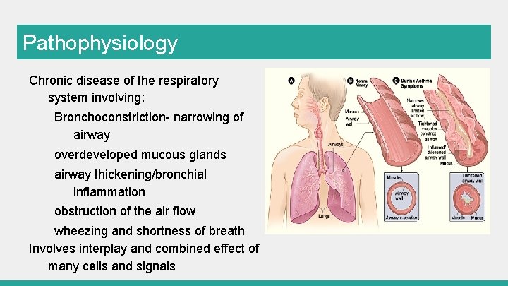 Pathophysiology Chronic disease of the respiratory system involving: Bronchoconstriction- narrowing of airway overdeveloped mucous