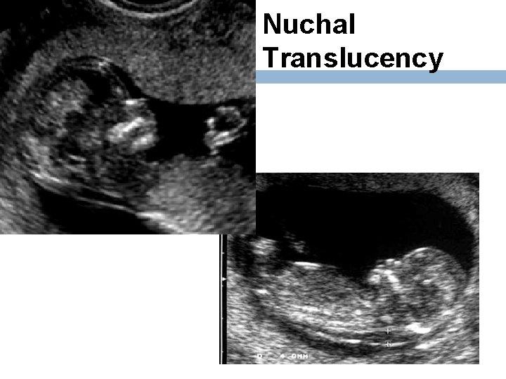 Nuchal Translucency 