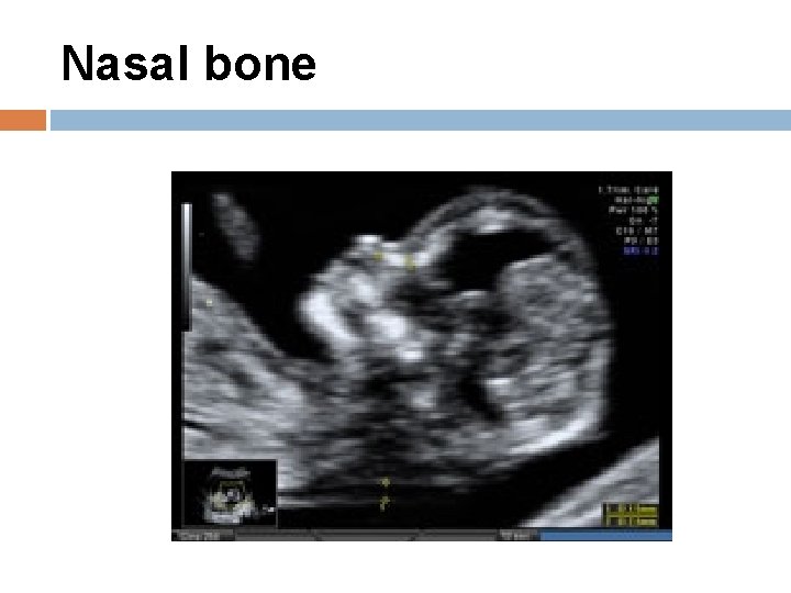 Nasal bone 