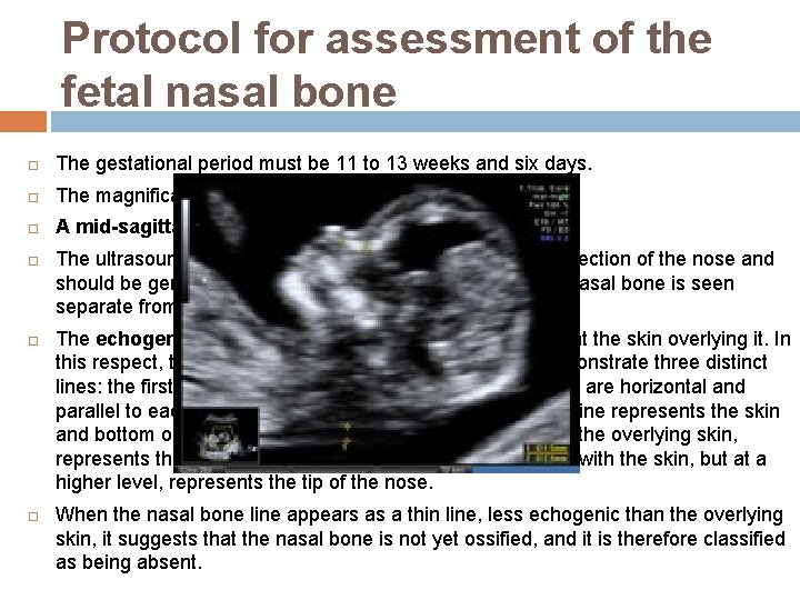 Protocol for assessment of the fetal nasal bone The gestational period must be 11