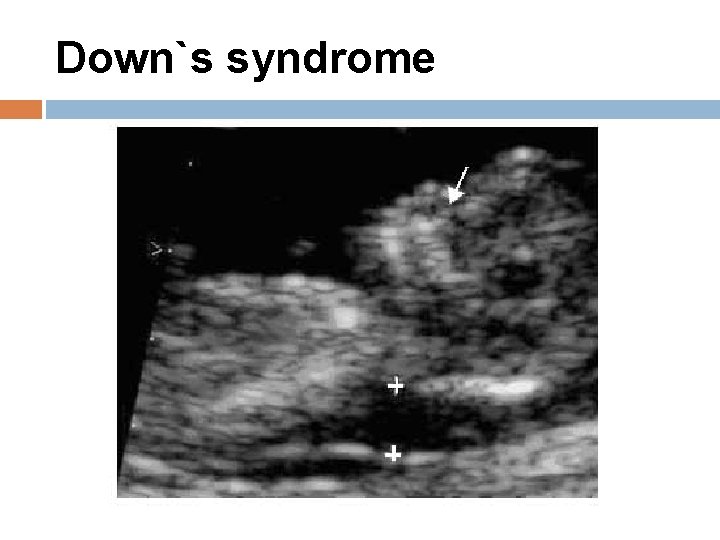 Down`s syndrome 