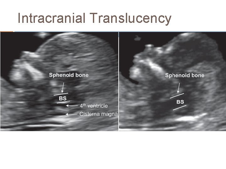 Intracranial Translucency 