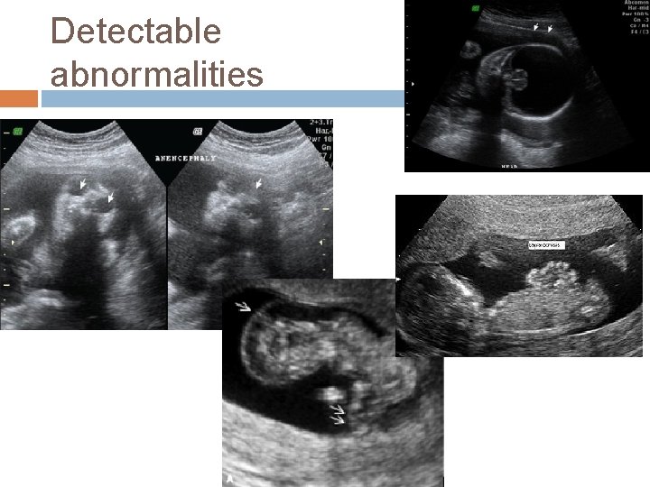 Detectable abnormalities 