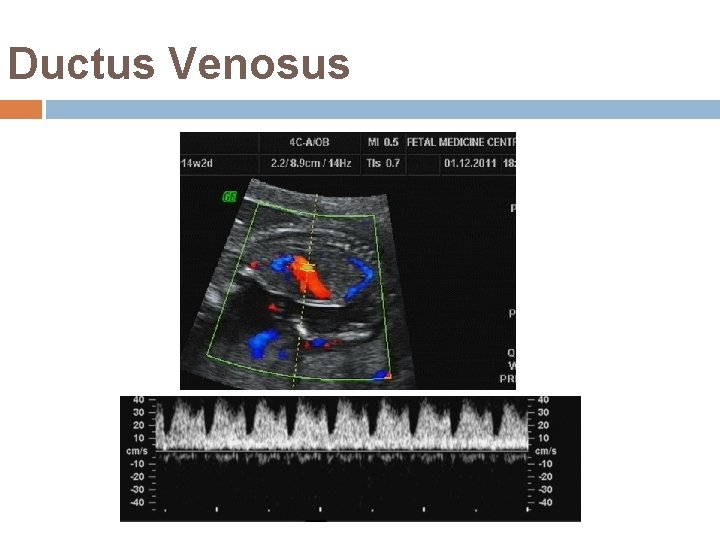 Ductus Venosus 