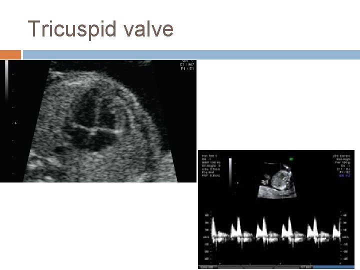 Tricuspid valve 