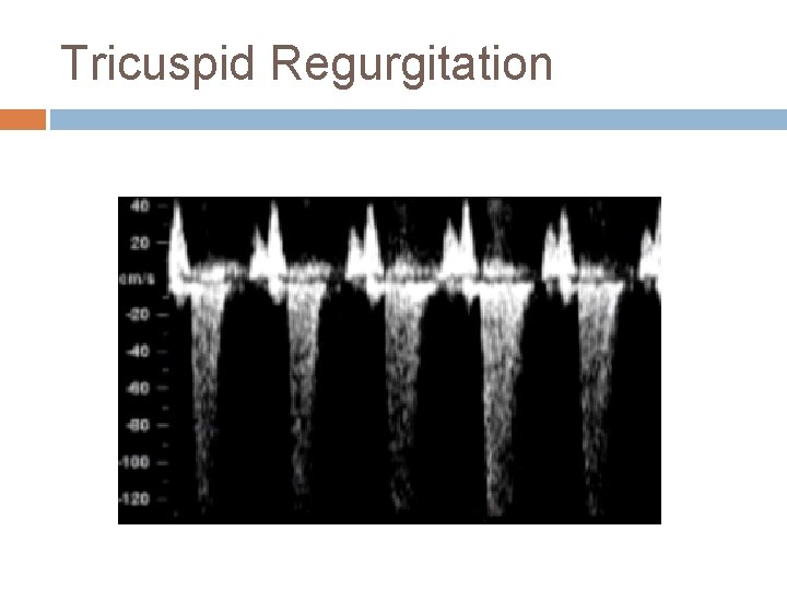 Tricuspid Regurgitation 