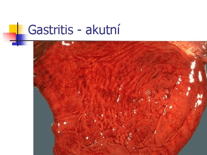 Gastritis - akutní 