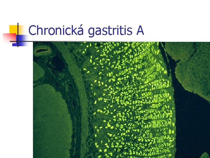 Chronická gastritis A 