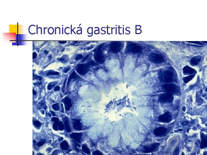 Chronická gastritis B 