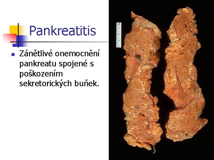 Pankreatitis n Zánětlivé onemocnění pankreatu spojené s poškozením sekretorických buňek. 
