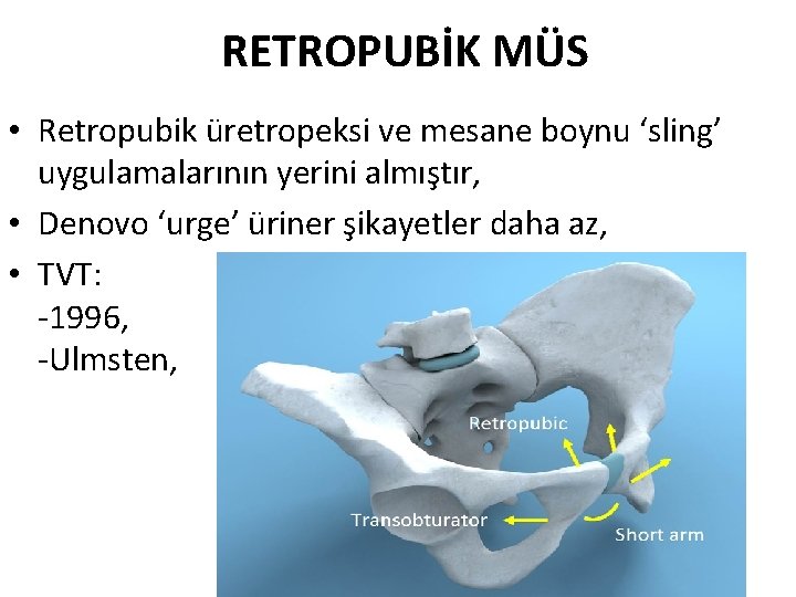 RETROPUBİK MÜS • Retropubik üretropeksi ve mesane boynu ‘sling’ uygulamalarının yerini almıştır, • Denovo