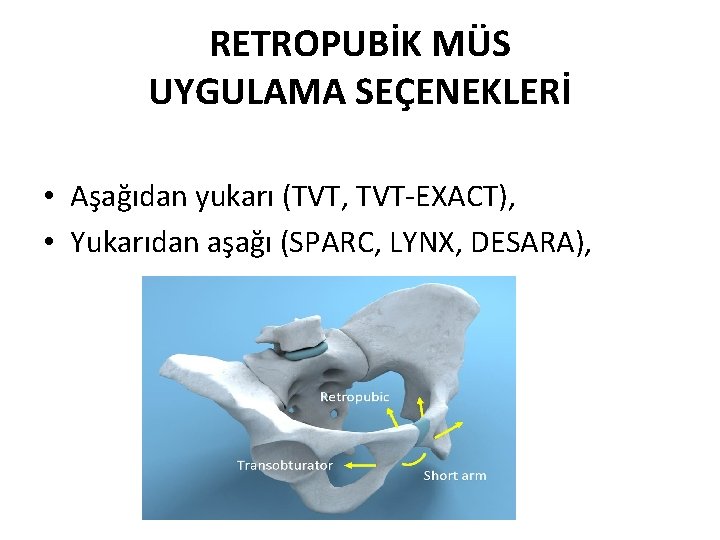 RETROPUBİK MÜS UYGULAMA SEÇENEKLERİ • Aşağıdan yukarı (TVT, TVT-EXACT), • Yukarıdan aşağı (SPARC, LYNX,