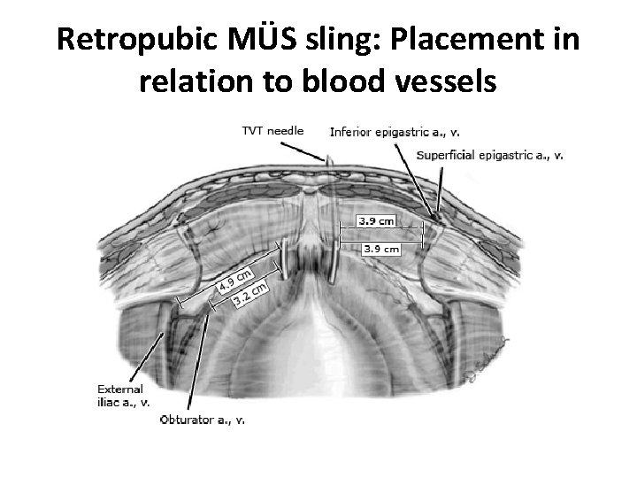 Retropubic MÜS sling: Placement in relation to blood vessels 