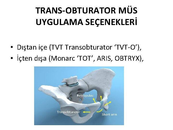 TRANS-OBTURATOR MÜS UYGULAMA SEÇENEKLERİ • Dıştan içe (TVT Transobturator ‘TVT-O’), • İçten dışa (Monarc