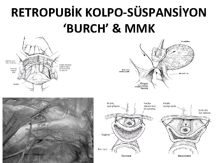 RETROPUBİK KOLPO-SÜSPANSİYON ‘BURCH’ & MMK 