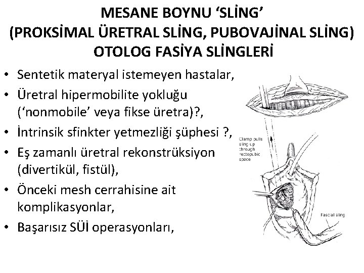 MESANE BOYNU ‘SLİNG’ (PROKSİMAL ÜRETRAL SLİNG, PUBOVAJİNAL SLİNG) OTOLOG FASİYA SLİNGLERİ • Sentetik materyal
