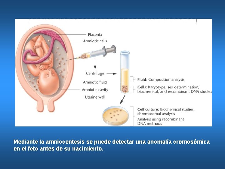 Mediante la amniocentesis se puede detectar una anomalía cromosómica en el feto antes de