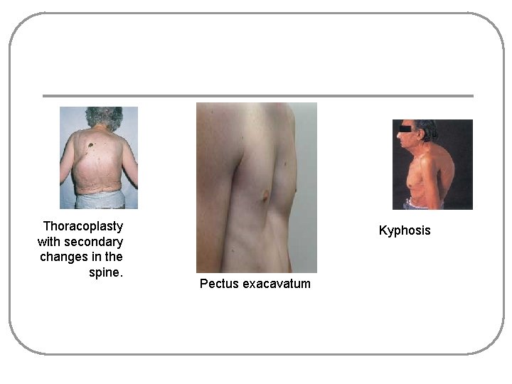 Thoracoplasty with secondary changes in the spine. Kyphosis Pectus exacavatum 