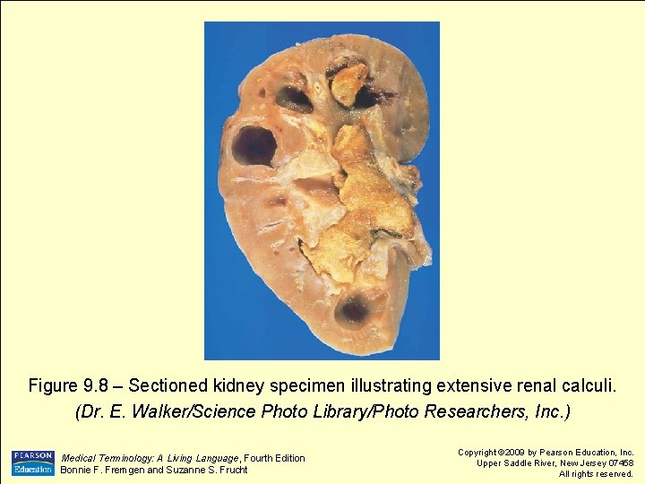 Figure 9. 8 – Sectioned kidney specimen illustrating extensive renal calculi. (Dr. E. Walker/Science