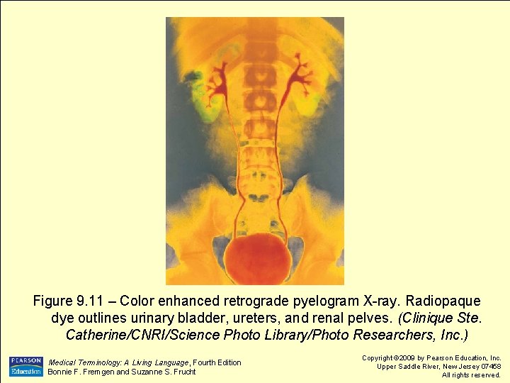 Figure 9. 11 – Color enhanced retrograde pyelogram X-ray. Radiopaque dye outlines urinary bladder,