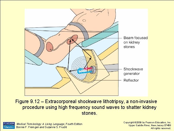 Figure 9. 12 – Extracorporeal shockwave lithotripsy, a non-invasive procedure using high frequency sound