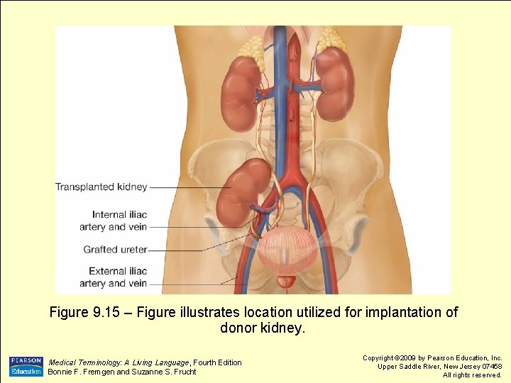 Figure 9. 15 – Figure illustrates location utilized for implantation of donor kidney. Medical