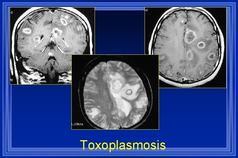 Toxoplasmosis 