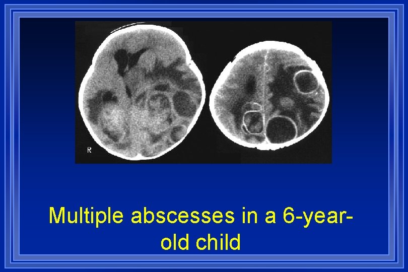 Multiple abscesses in a 6 -yearold child 