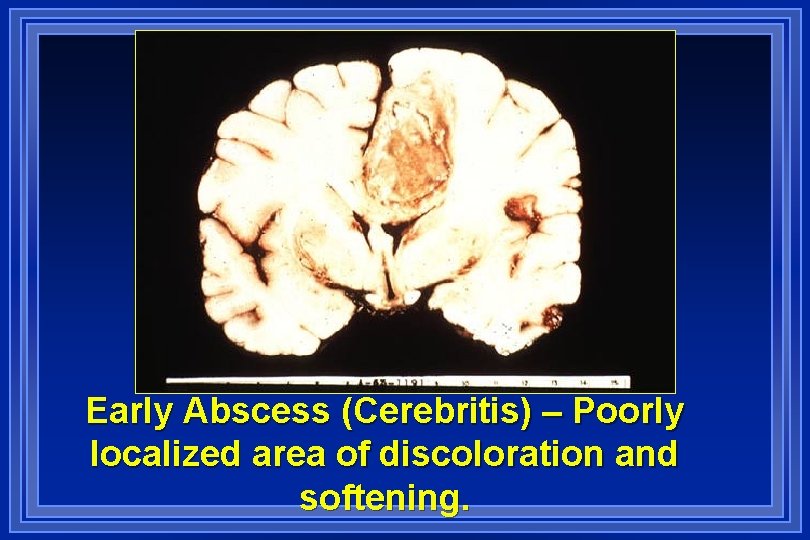 Early Abscess (Cerebritis) – Poorly localized area of discoloration and softening. 