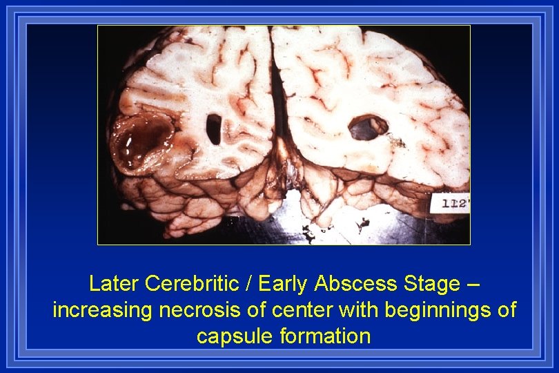 Later Cerebritic / Early Abscess Stage – increasing necrosis of center with beginnings of